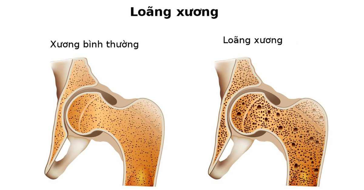 Tìm hiểu về bệnh loãng xương