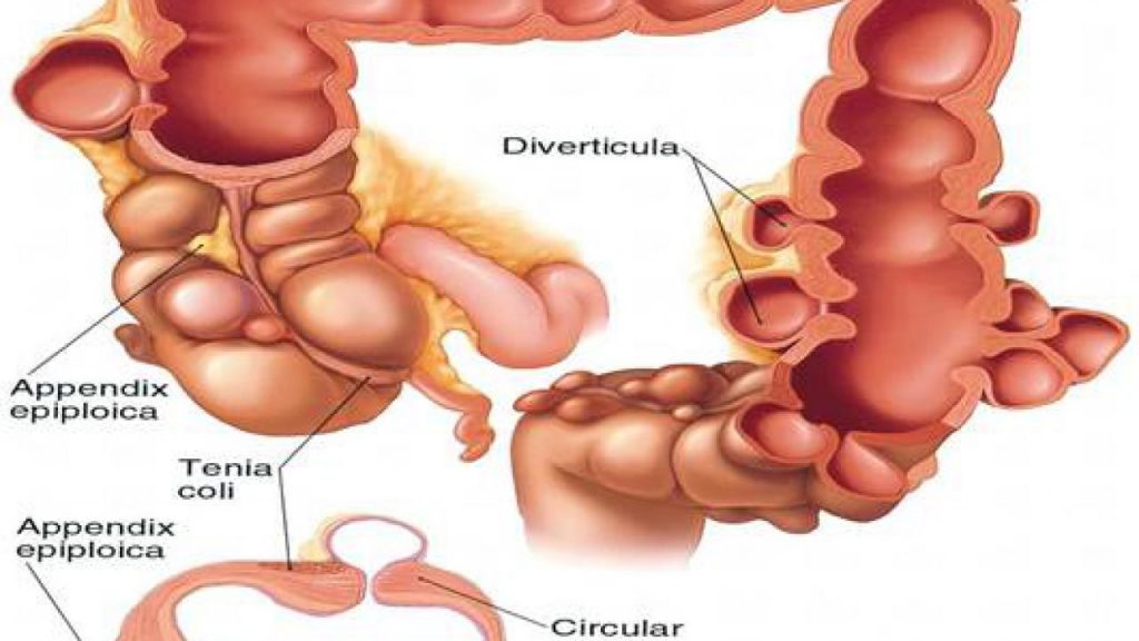 Tìm hiểu và phòng tránh bệnh túi thừa đại tràng